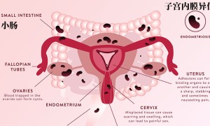 肠子宫内膜异位症——多少患者存在？