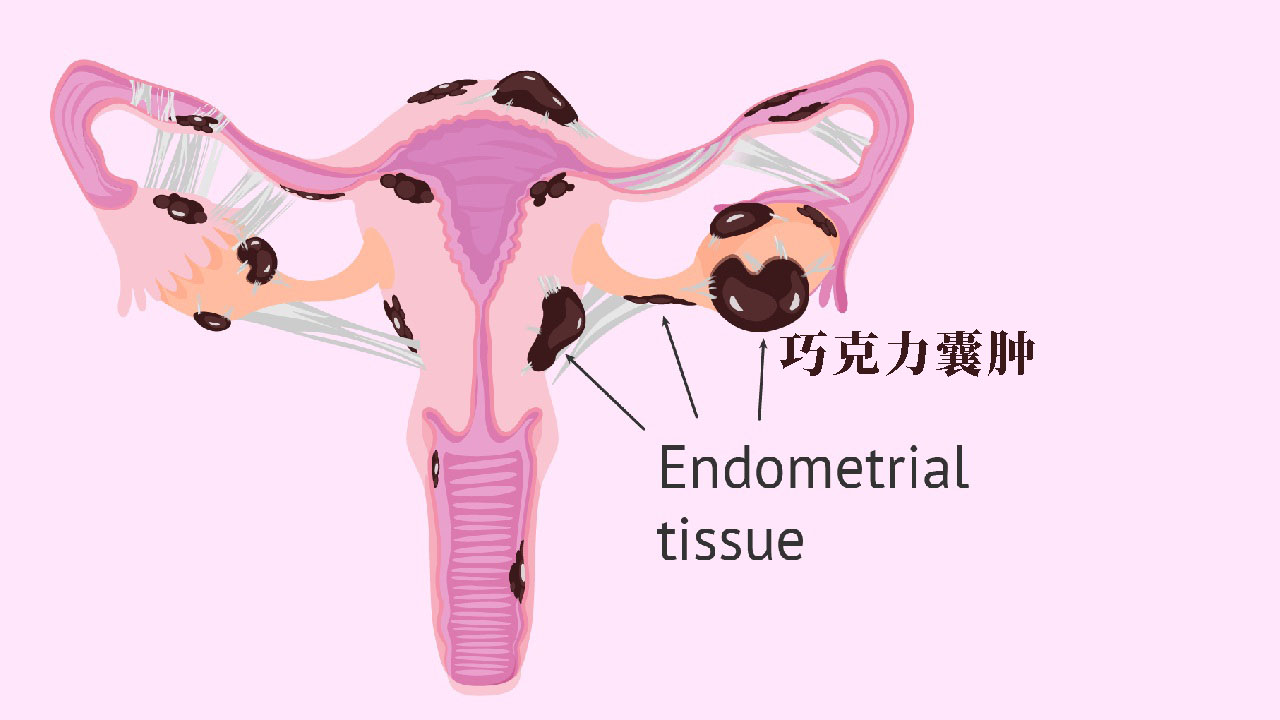 巧克力囊肿是什么原因引起的该怎么治疗