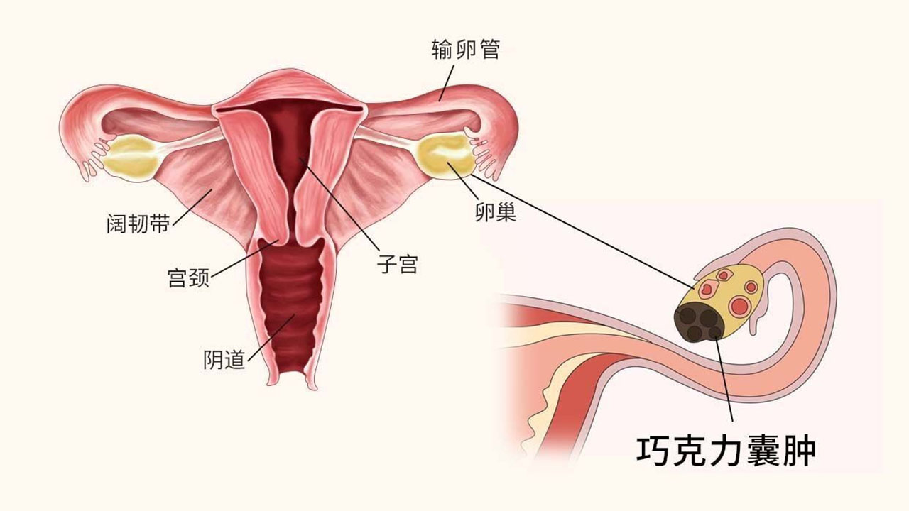 卵巢巧克力囊肿怎么治疗效果最好